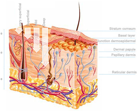 Peeling-types-Tunisia